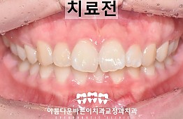 수술전