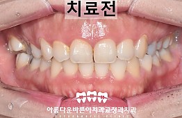 수술전