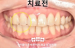 수술전