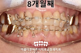 수술후