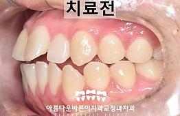 수술전