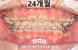 수술후