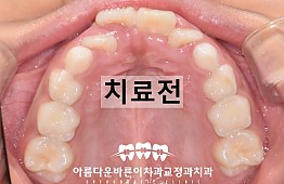 수술전