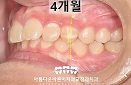 수술후