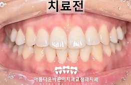 수술전