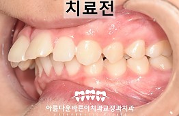 수술전