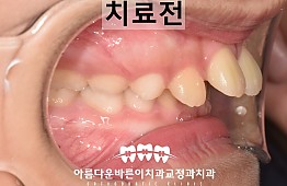 수술전