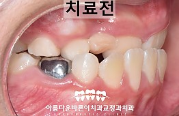 수술전