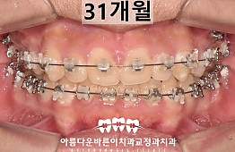 수술후