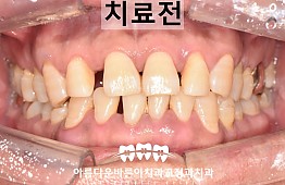 수술전