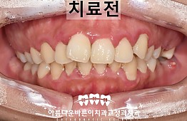 수술전