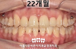 수술후