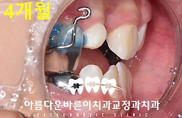 수술후