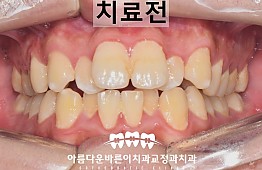 수술전