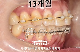 수술후