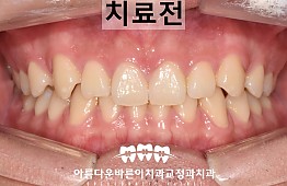 수술전