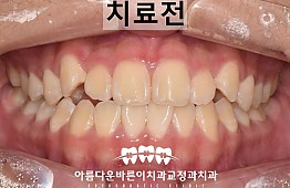 수술전