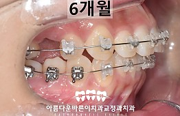 수술후