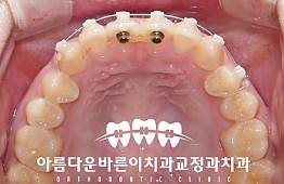 수술후