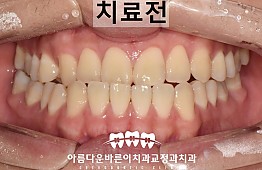 수술전