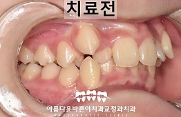 수술전