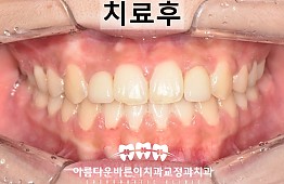 수술후