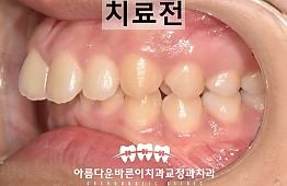 수술전