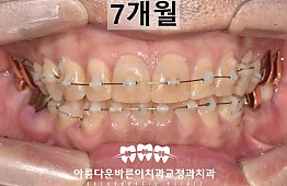 수술후