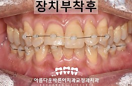 수술후