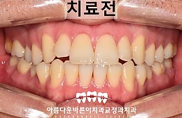 수술전