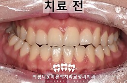 수술전