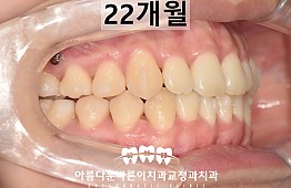 수술후