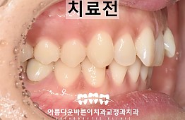 수술전