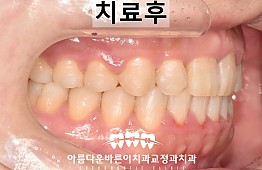 수술후