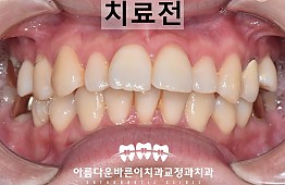 수술전