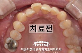 수술전