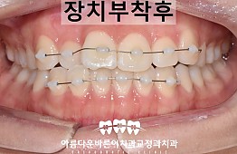 수술후