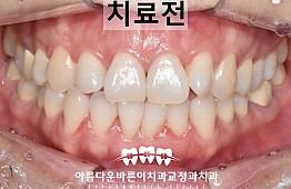 수술전