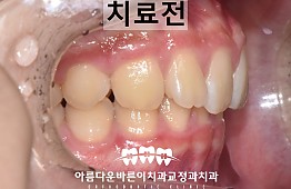 수술전