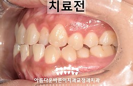 수술전