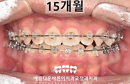 수술후