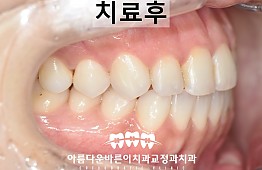 수술후