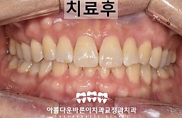 수술후