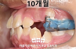 수술후