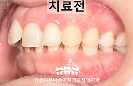 수술전