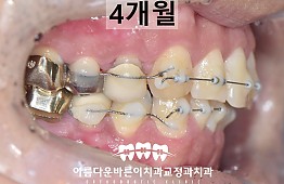 수술후