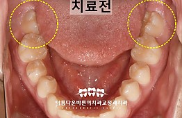 수술전