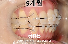 수술후