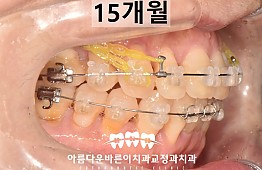 수술후