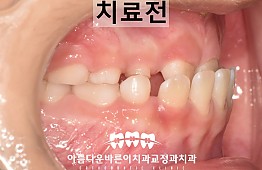 수술전